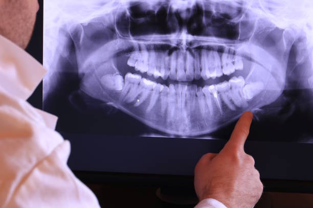 Best Emergency Wisdom Tooth Extraction in Alton, IL